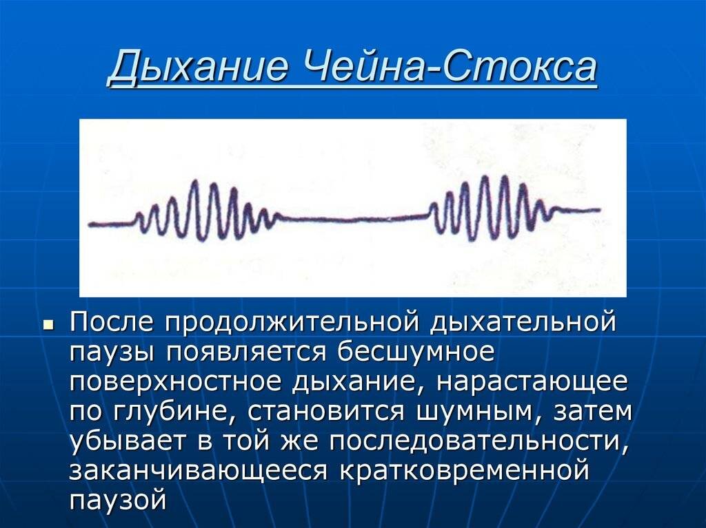 Сонное апноэ: как обнаружить и что с ним делать?