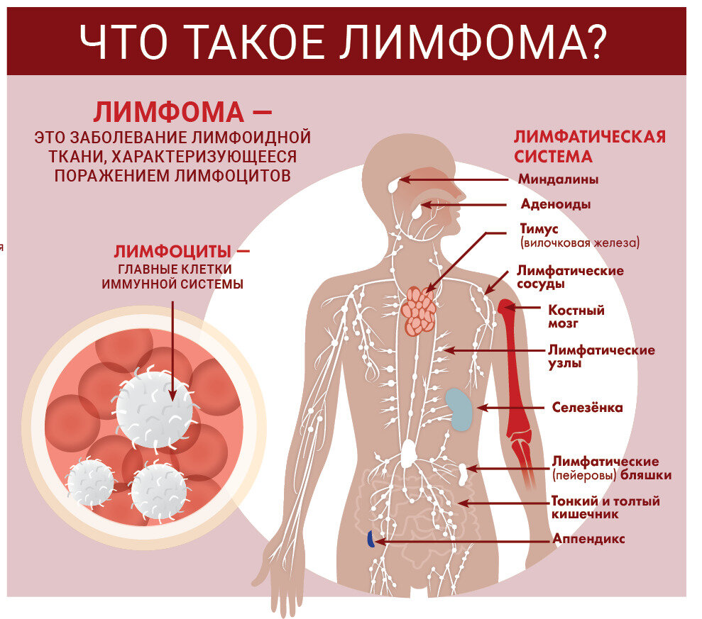 Лимфома в детском возрасте