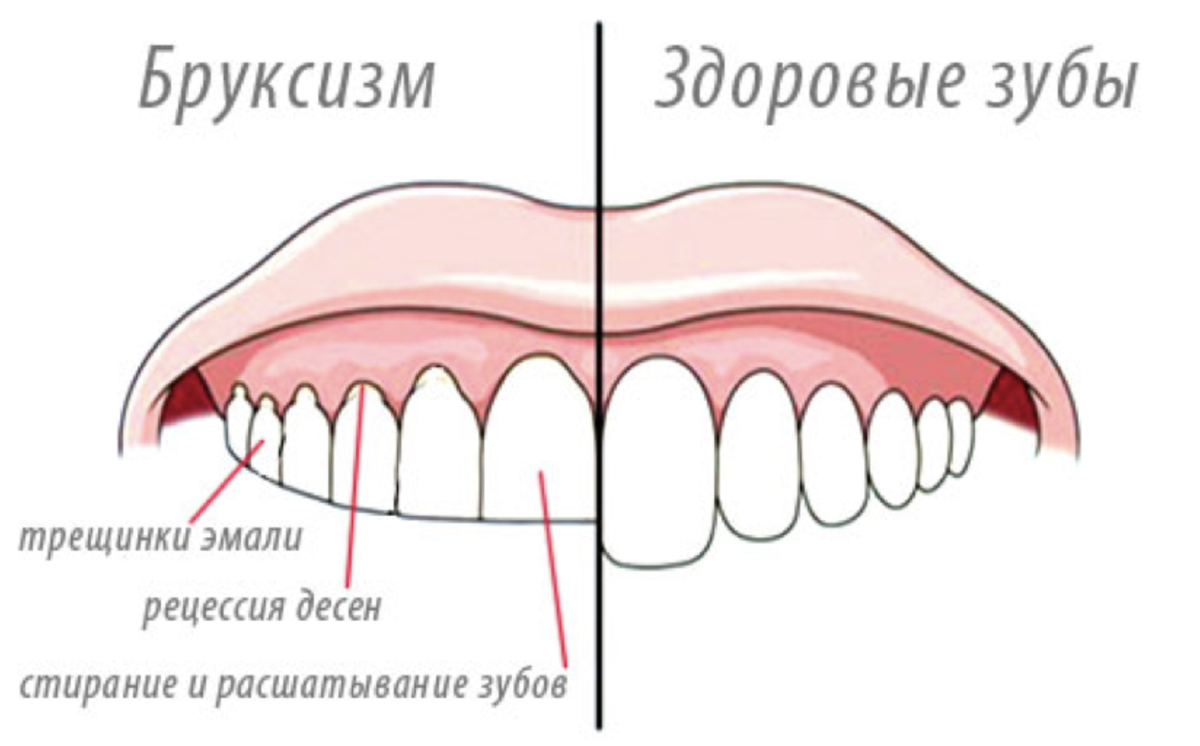 Почему скрипят зубами днем