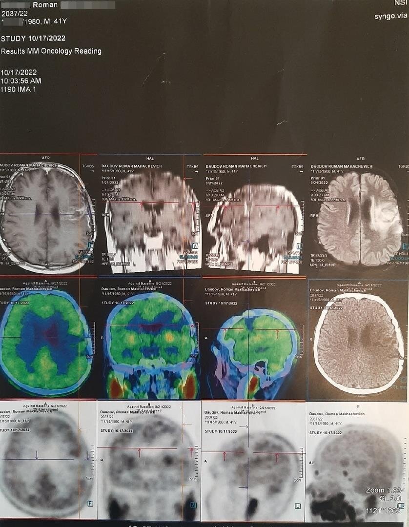 Рак мозга. Долгожданный результат ПЭТ КТ, слезы в Бурденко и консультация  нейрохирурга. | Фаршики | Дзен