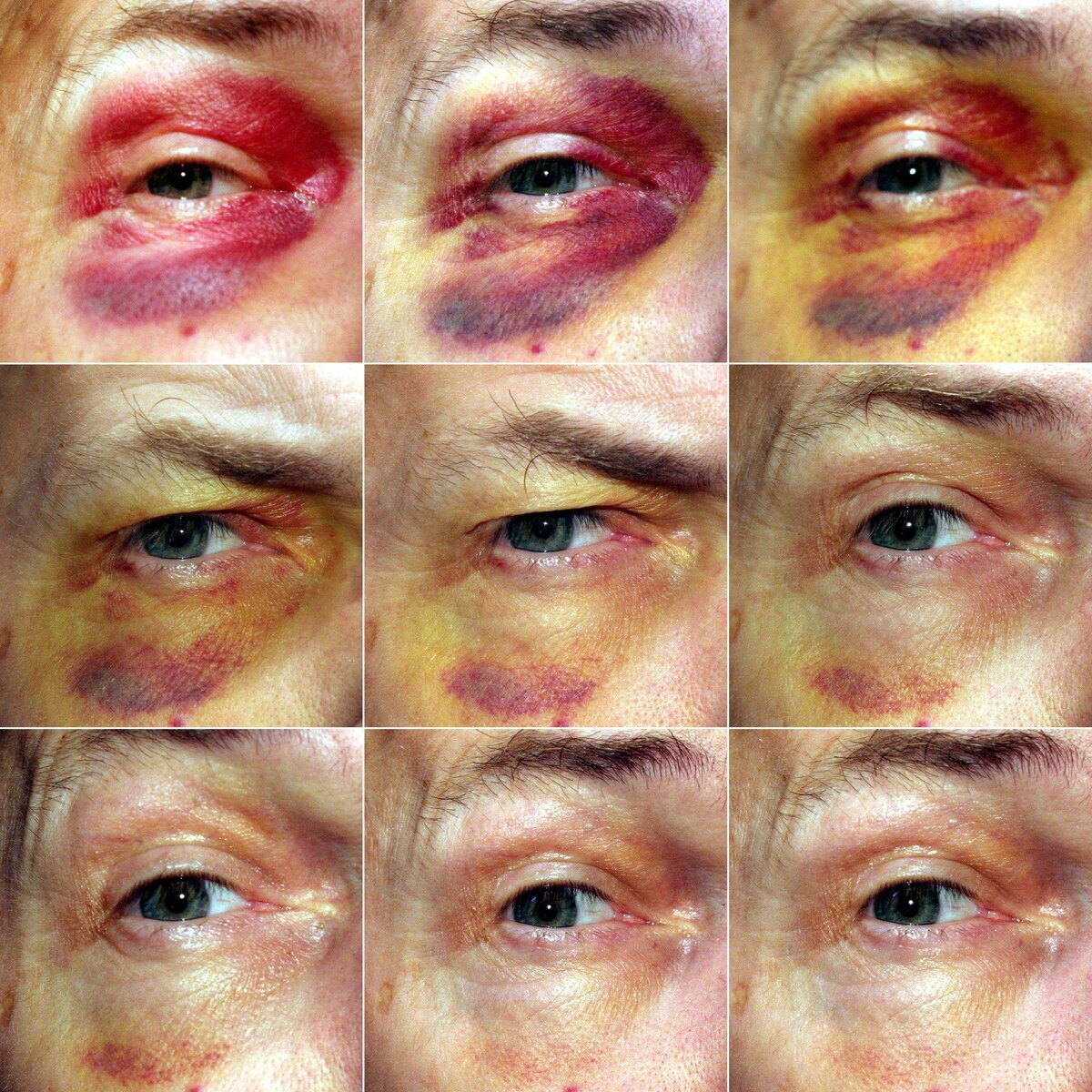 Как лечить синяк под глазом: серьезно ли это?