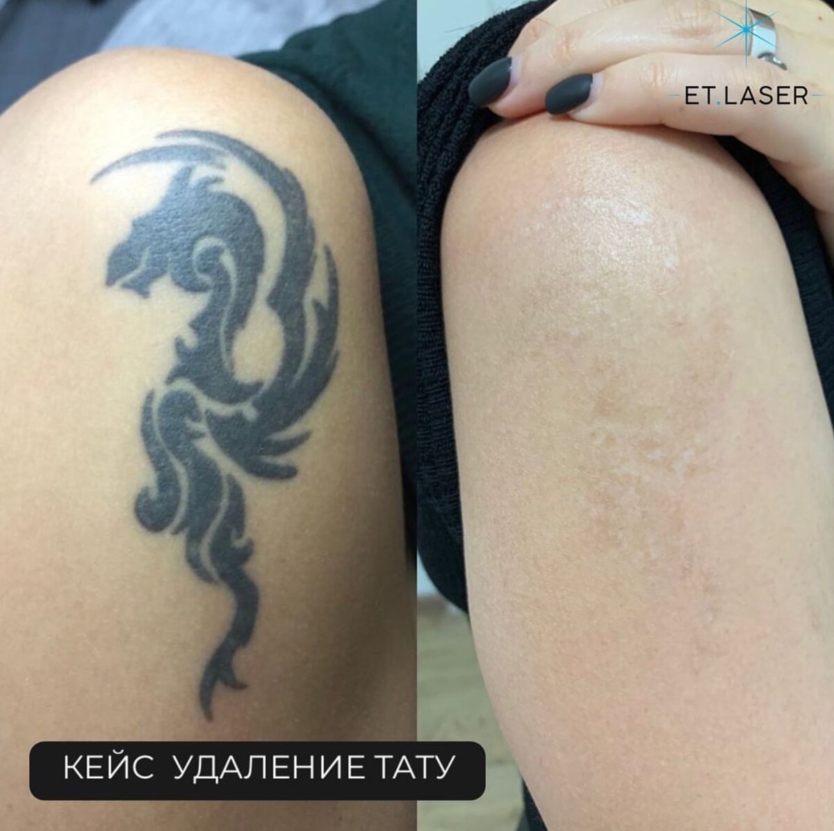 Как можно удалить тату? | статья от экспертов клиники Premium Aesthetics.