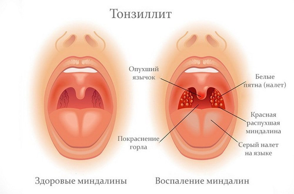 Какое горло при ангине фото у взрослого