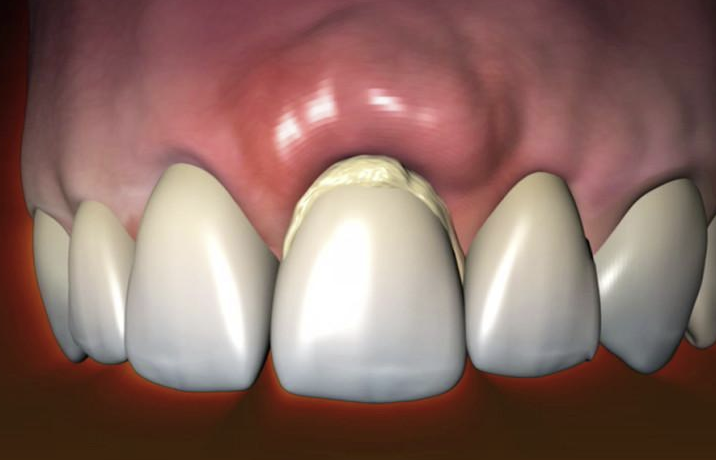 Посинела десна после протезирования, лечения или удаления зуба, что делать?