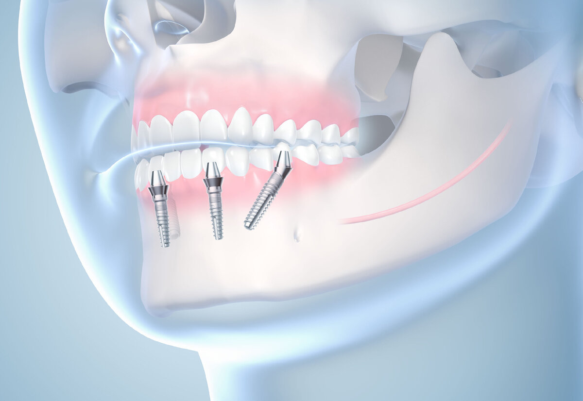 Зубы на четырех имплантах. Современный имплантант зубов. Методы имплантации зубов.