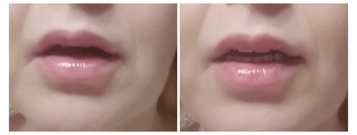 Разница между старым и новым протезом. Старый просел и его совсем не видно