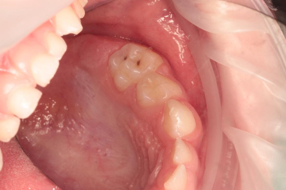 Лечение кариеса молочных зубов
