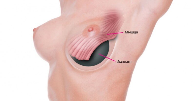 Возможные осложнения после маммопластики. Стоит ли их бояться?
