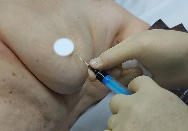 Параареолярное введение препарата индоцианина зелёного (ICG - indocyanine green)