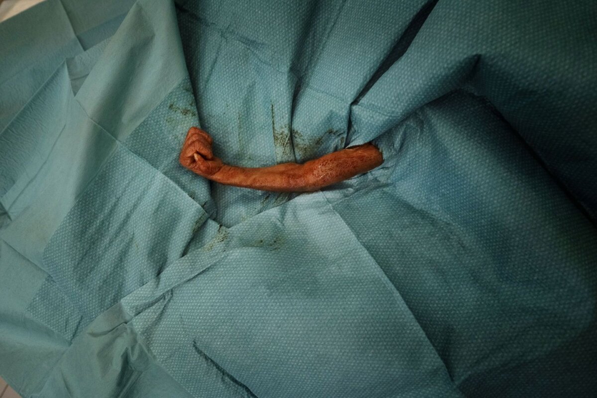 Baby Orangutan Surgery by Alain Schroeder