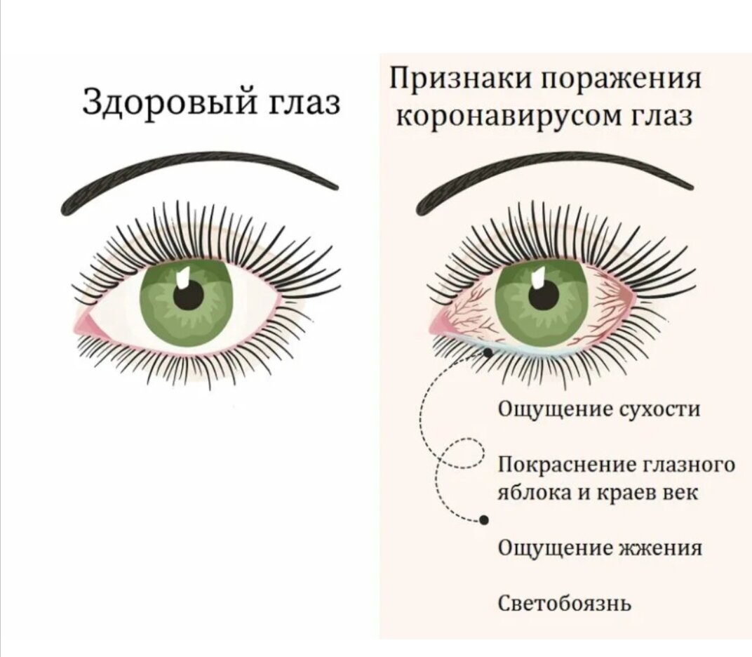 Эффективные методы улучшения состояния глаз при коронавирусной инфекции. |  АКАДЕМИЯ ОХРАНЫ ЗРЕНИЯ. Арановская Ольга | Дзен