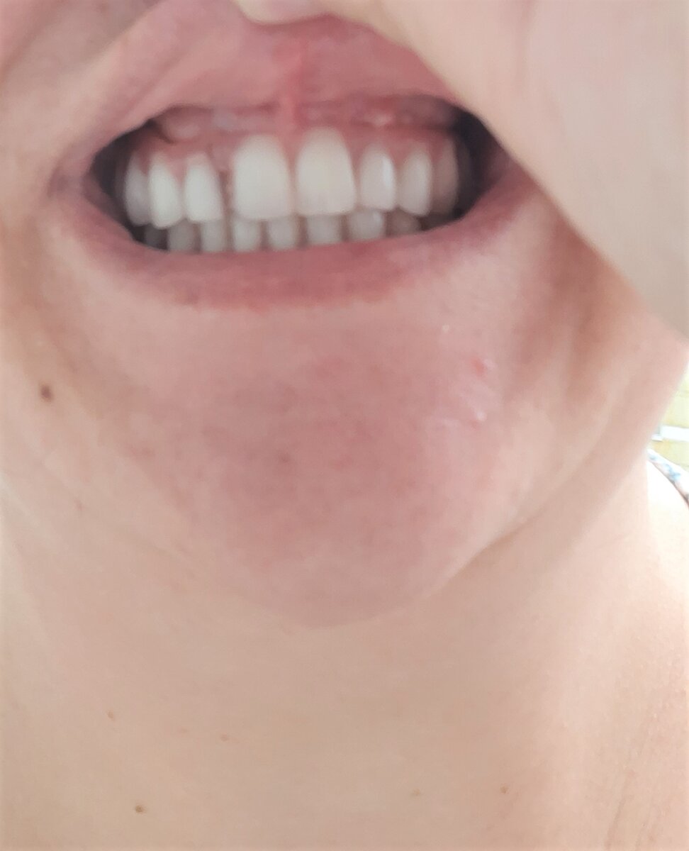 А это сейчас. На стык внимания не обращайте, на постоянном протезе его не будет. Раньше, протез все время ломался именно в том месте где теперь стык. Пластика стало меньше в разы!!! Это очень круто. За качество фото прошу прощения.