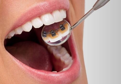 Лингвальные брекеты