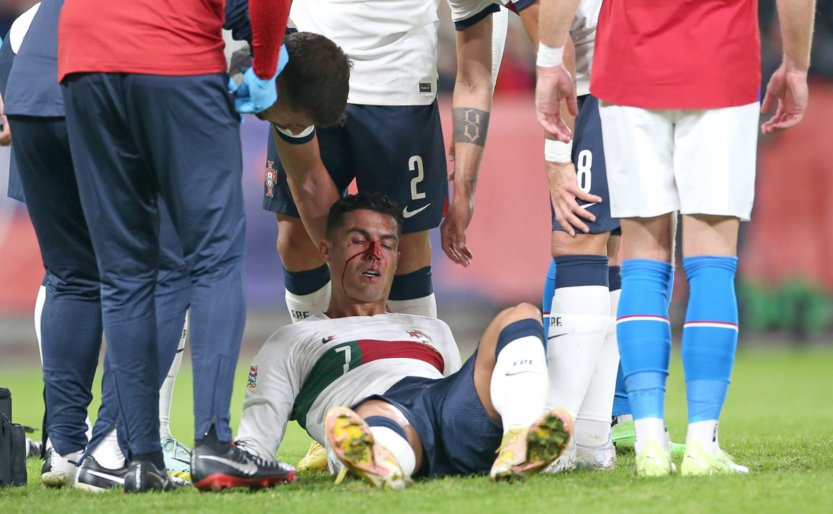 Криштиану Роналду разбил нос в матче против Чехии. Фото: globallookpress