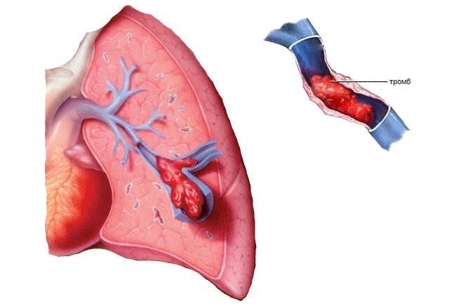 Тромбоэмболия легочной артерии-жизнеугрожающее состояние, может привести к летальному исходу.