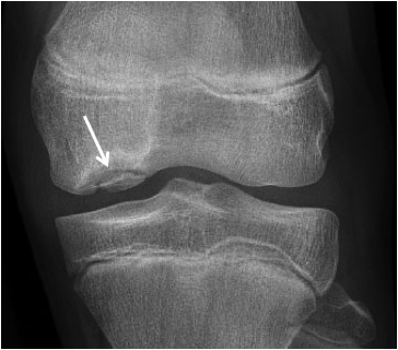 
Обычный рентгеновский снимок — лучшее начальное исследование, которое может помочь в диагностике