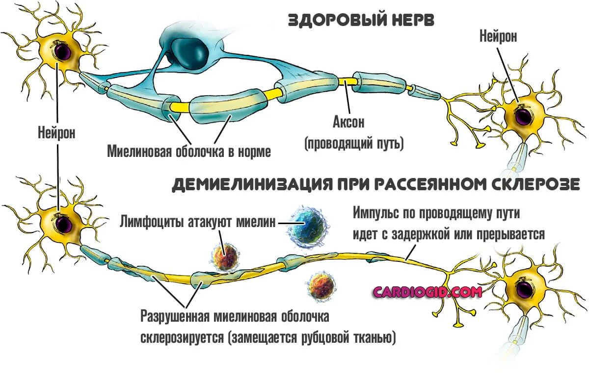 Рассеянный склероз картинки для презентации