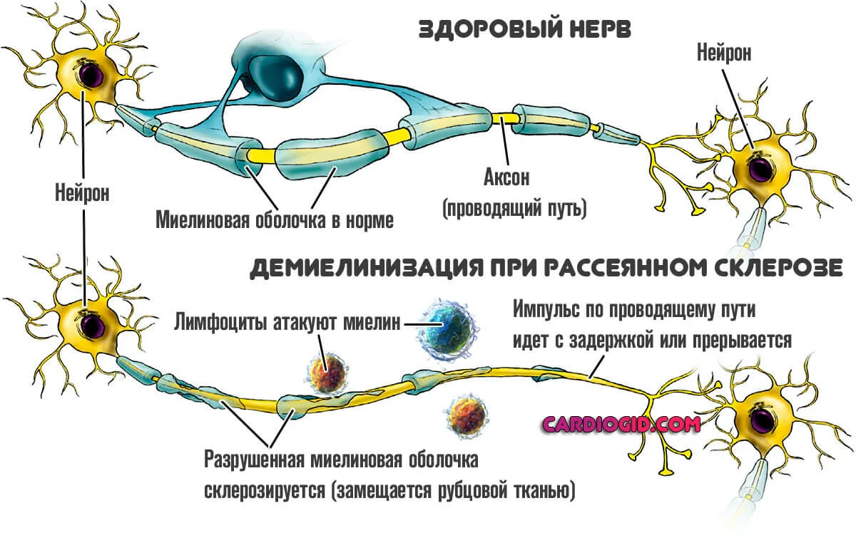 Стволовые клетки рассеянный склероз пирогов