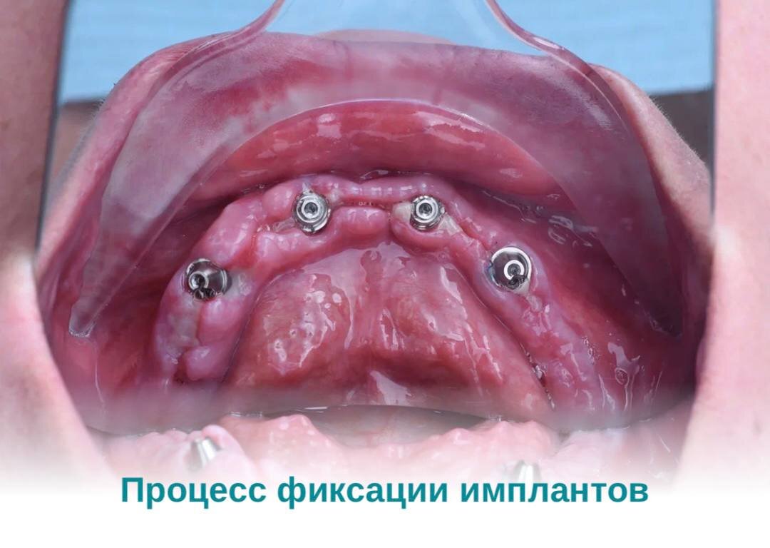 Процесс фиксации имплантов