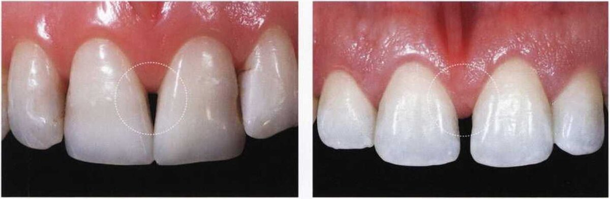 На картинке слева – треугольная форма центральных резцов приводит к образованию "черного треугольника" у десны.