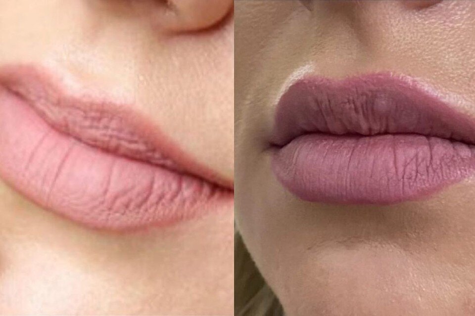     Гель, который вкололи девушке, скатался шариками. Фото: предоставлено Алисой