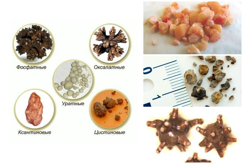 Ураты и оксалаты. Мочекаменная болезнь камни в мочевом пузыре. Разновидности камней в мочевом пузыре. Уратный -фосфатный камень в почке. Мочекаменная болезнь оксалатные камни.