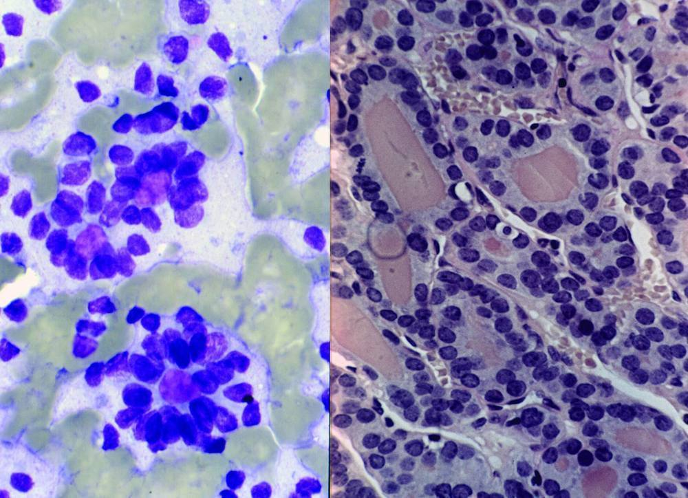 Цитологическая картина зоба с кистозной дегенерацией