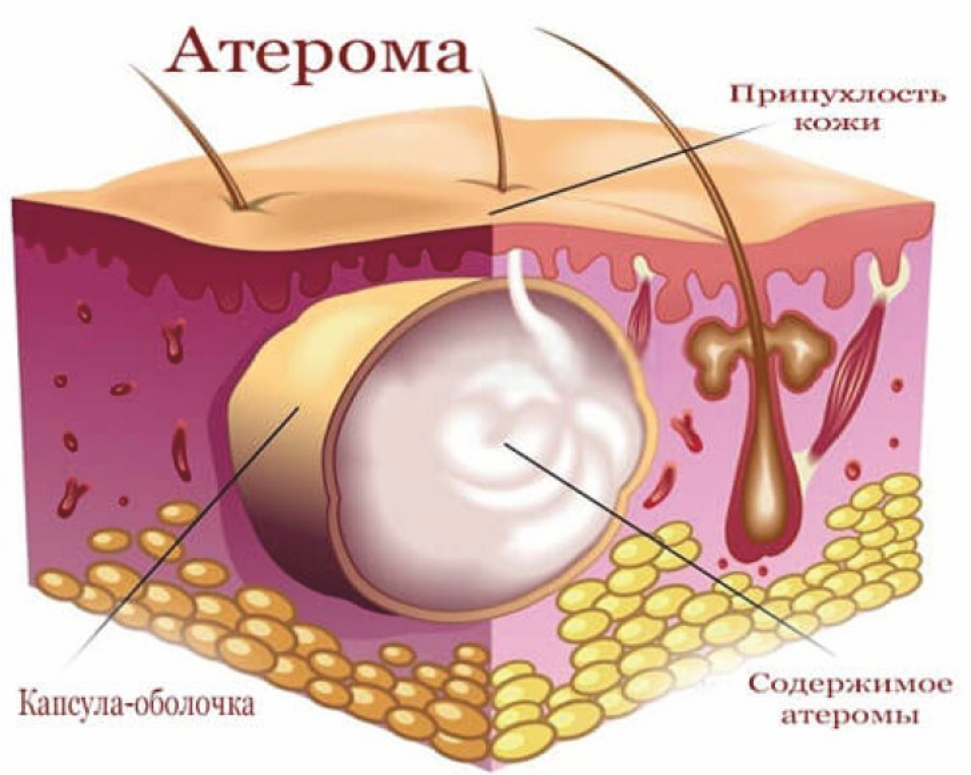 Атерома цитологическая картина