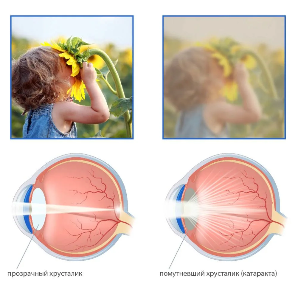 Офтальмолог ответил на главные вопросы про катаракту и глаукому | Эксимер,  офтальмологическая клиника | Дзен