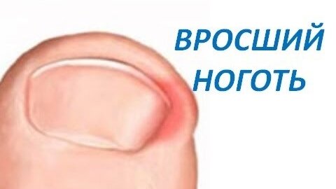 Вросший ноготь