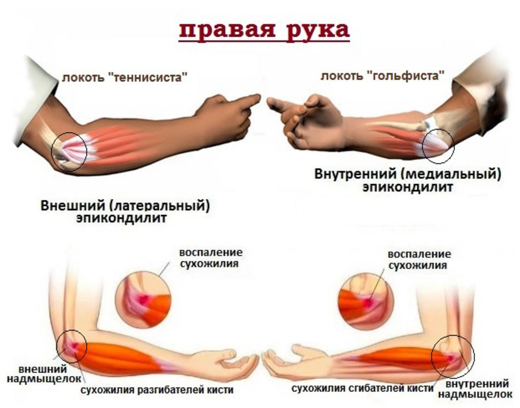 Латеральный эпикондилит локтевого сустава что. Латеральный эпикондилит локтевого сустава симптомы. Эпикондилит локтевого отростка. Латеральный и медиальный эпикондилит локтевого сустава. Медиальный эпикондилит сухожилия