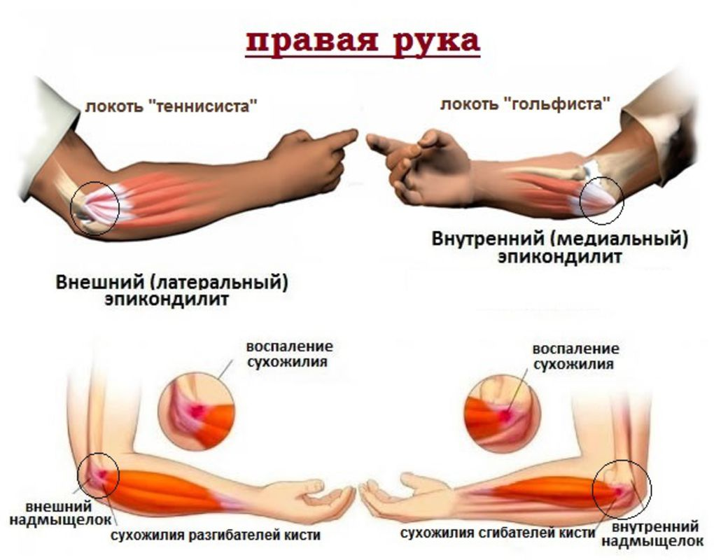 Наружный эпикондилит локтевого