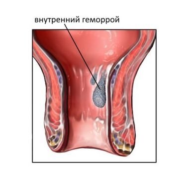 Лечение геморроя: причины, симптомы у мужчин и женщин