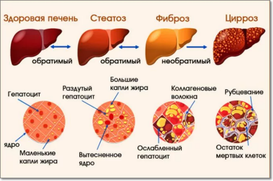 здоровая и больная печень