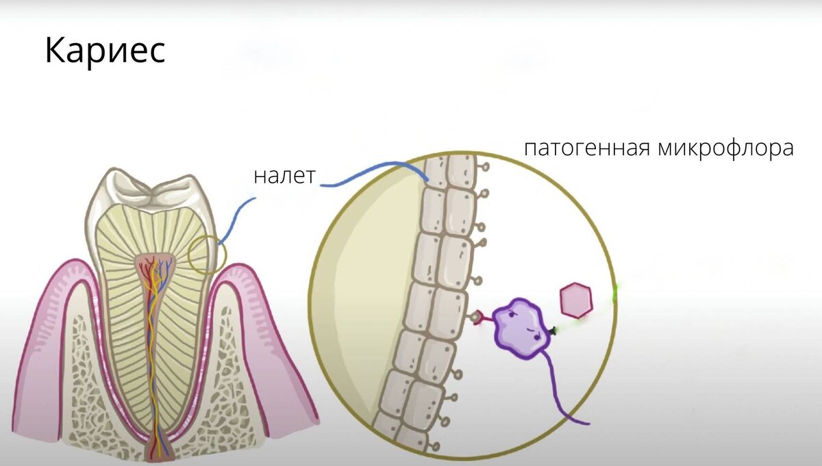 Причины и возбудитель зубной боли при кариесе. Анимация автора.