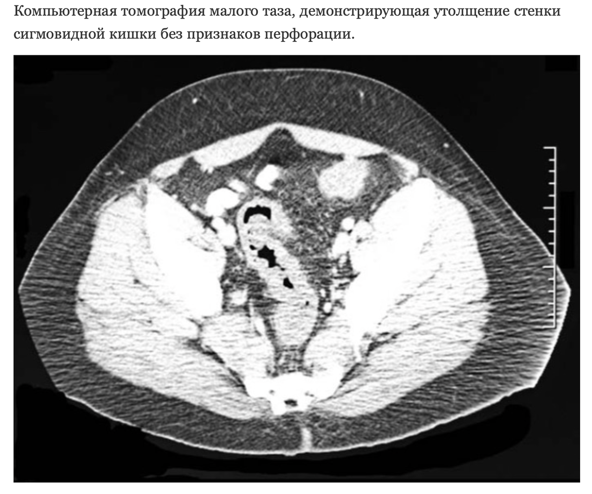 Клизма для получения удовольствия