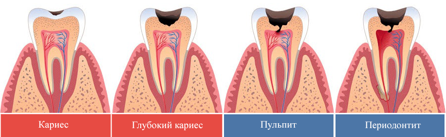 Стадии развития кариеса и его осложнений до периодонтита.