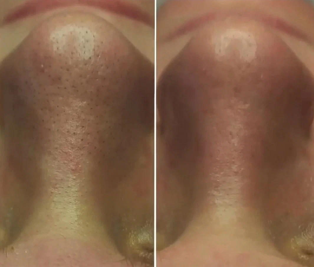 Процедура HydraFacial фото до и после. Фото с сайта Д.Р. Гришкяна. Имеются противопоказания, требуется консультация специалиста