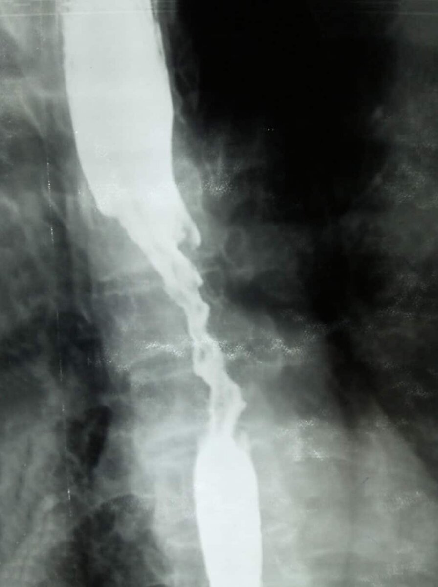O radiografie cu contrast cu bariu arată distorsiunea lumenului esofagului și îngustarea acestuia.  Link către sursa imaginii: https://clck.ru/32UzCF