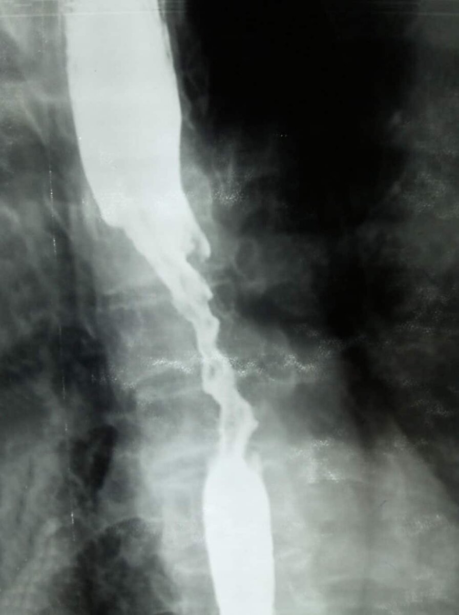 На рентгенограмме с бариевым контрастом видно искажение просвета пищевода и его сужение. Ссылка на источник изображения: https://clck.ru/32UzCF