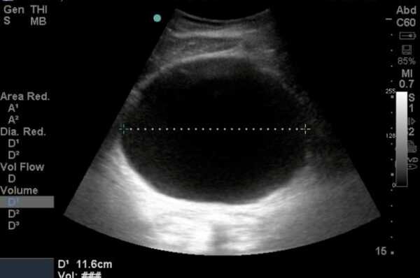 Округлая черная структура это заполненный мочевой пузырь