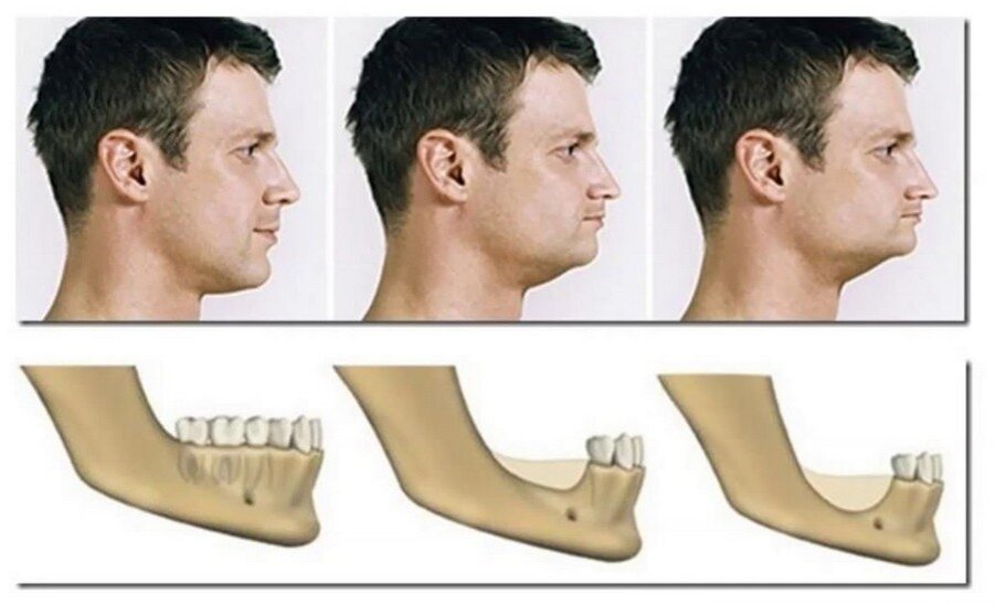 Атрофия костной ткани негативно сказывается на внешности людей. Картинка из свободных источников.