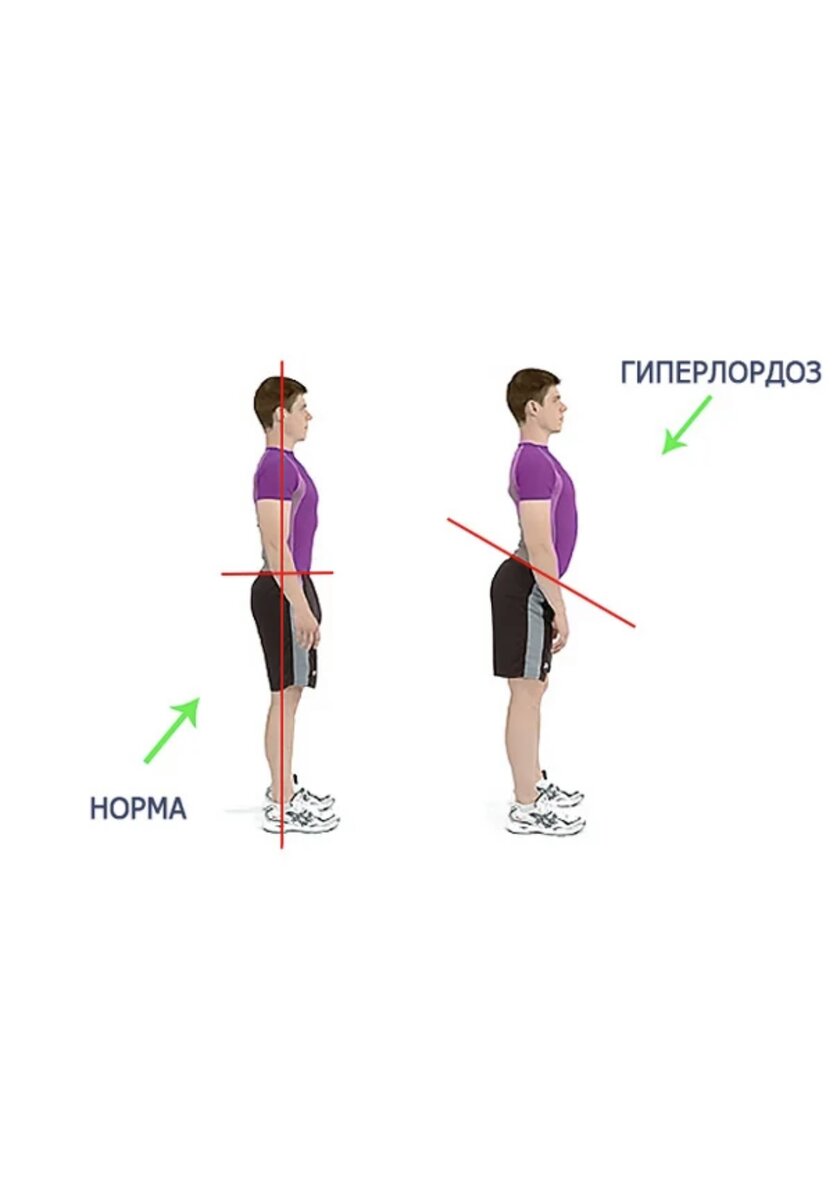 Лордоз: причины, симптомы, лечение