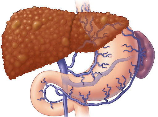 Портальная гипертензия (портальная гипертония) – одно из наиболее тяжелых последствий тромбоза воротной вены 