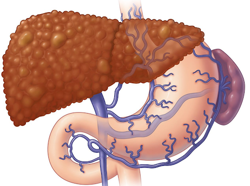 Портальная гипертензия что это