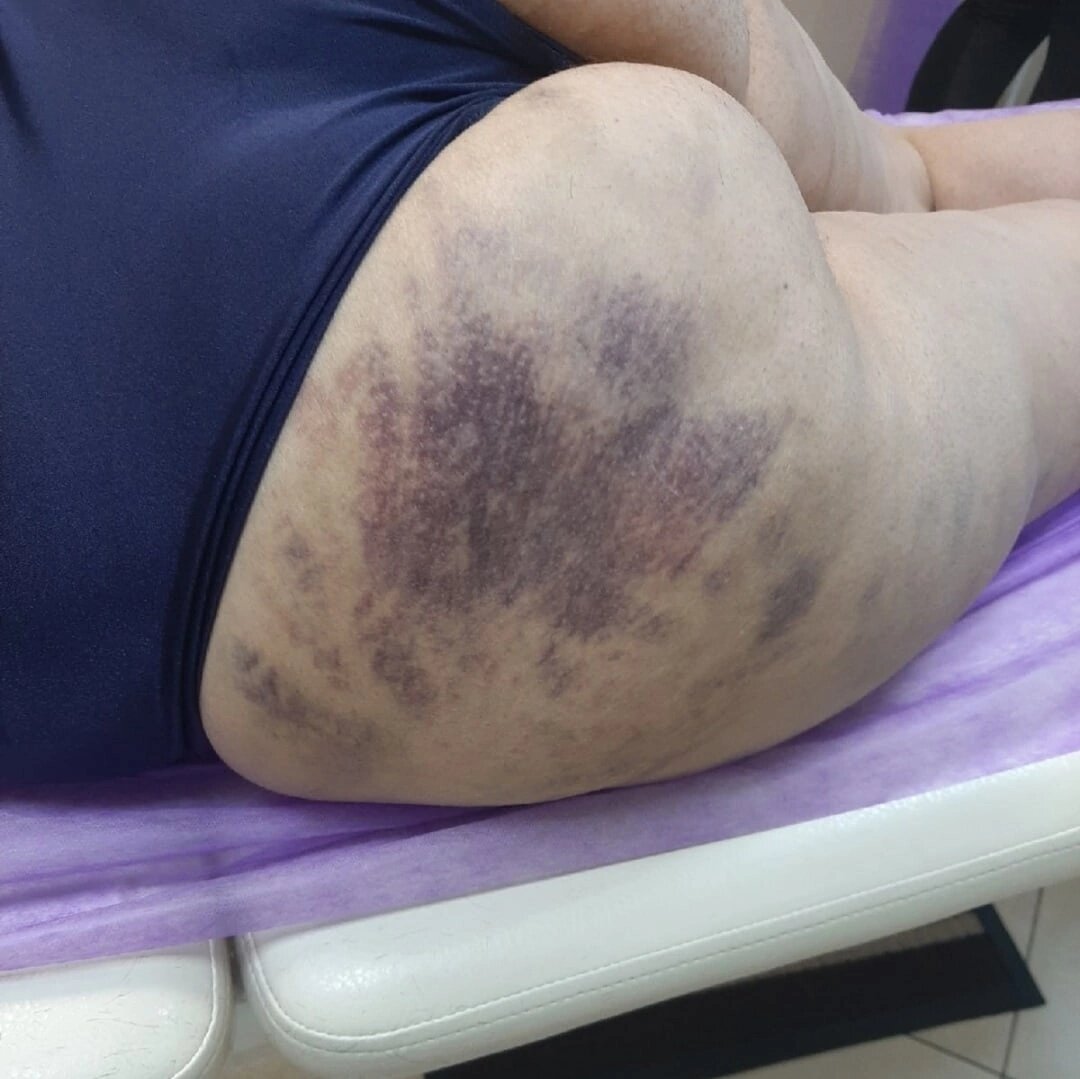 Результат от не правильного массажа