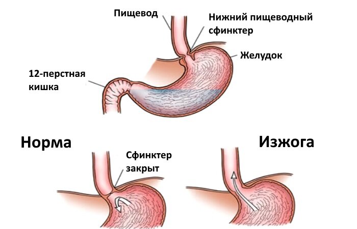 Изжога: как избавиться, что помогает, причины, симптомы, способы устранения