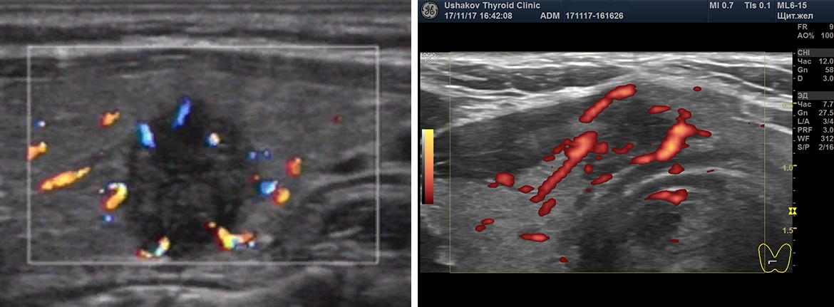 Усиленная васкуляризация. Перинодулярный кровоток узла щитовидной. Допплерометрия щитовидной железы. Цветное допплеровское картирование щитовидной железы. УЗИ щитовидной железы с допплерографией.