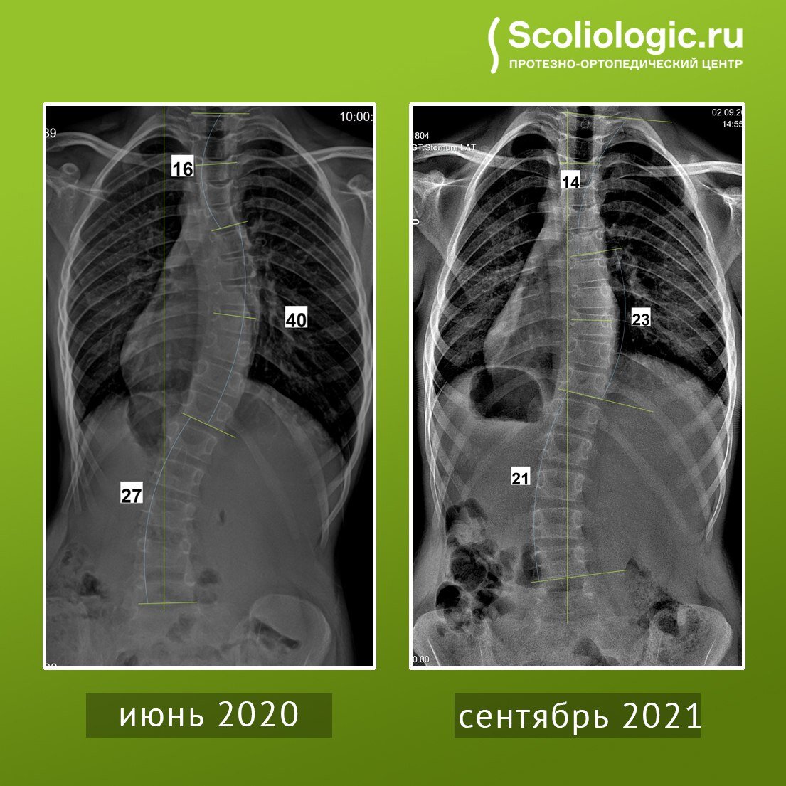 Сколиолоджик до и после