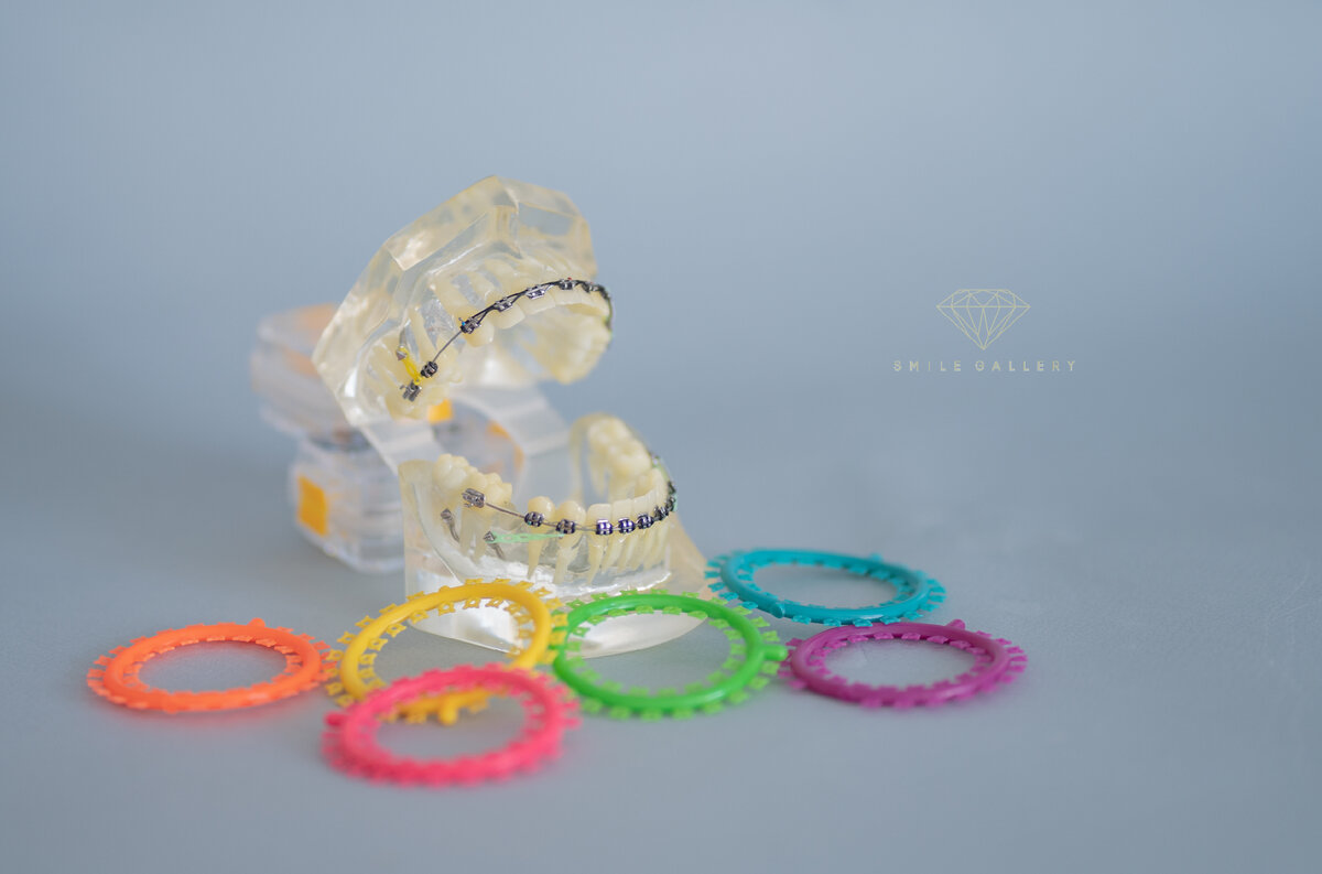 Резинки на брекеты предназначены для усиления воздействия брекет-системы